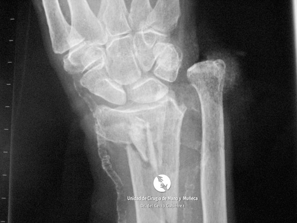 Fractura del Radio de la Muñeca 1 Fractura del Radio FEDR ARTICULAR