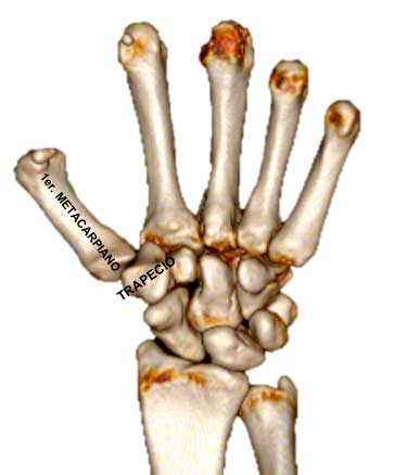 Rizartrosis Artrosis del Pulgar 10 Rizartrosis 1