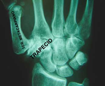 Rizartrosis Artrosis del Pulgar Diagnóstico de la rizartrosis o artrosis del dedo pulgar de la mano