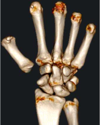 Rizartrosis Artrosis del Pulgar extirpación del trapecio y colocación entre primer y segundo metacarpiano