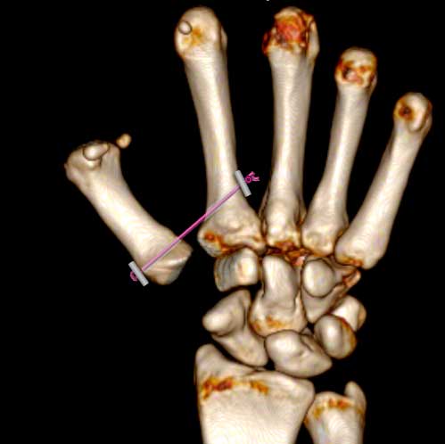 Rizartrosis Artrosis del Pulgar colocación de un espaciador entre primer y segundo metacarpiano tras extirpación del trapecio