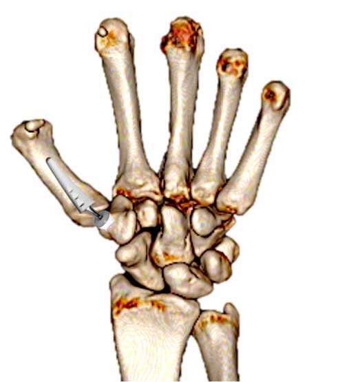Rizartrosis Artrosis del Pulgar Prótesis trapeciometacarpiana. (Tratamiento 3).