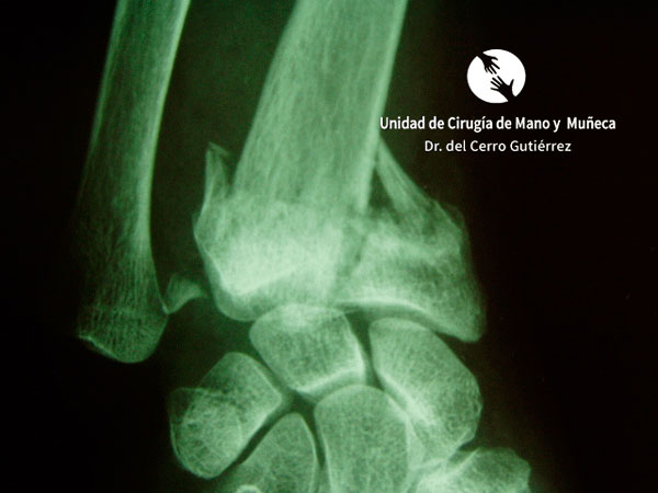 Fractura del Radio de la Muñeca Fractura del Radio. Avulsión Estiloides.