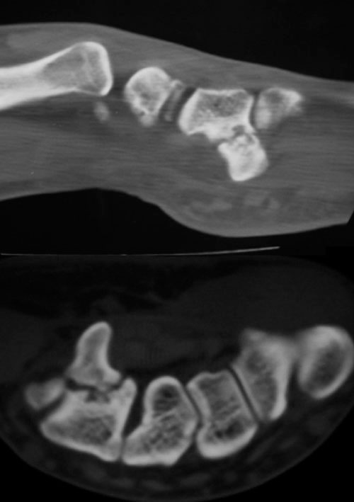 Síndrome del Canal de Guyon Radiografía de Fractura de la apófisis unciforme del hueso ganchoso