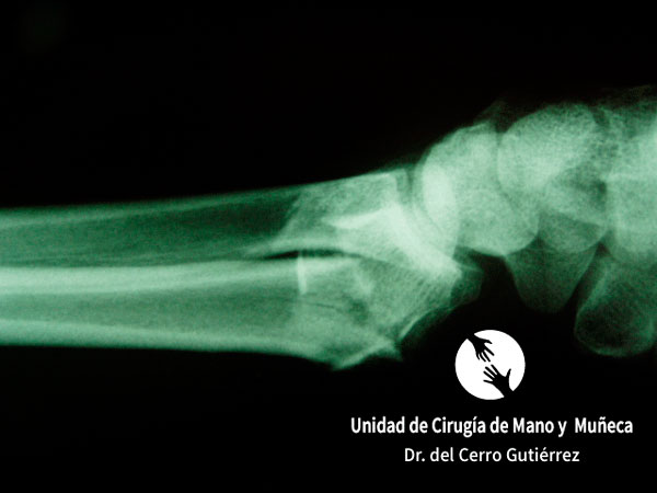 Fractura del Radio de la Muñeca Fractura del Radio. Desplazamiento Dorsal.