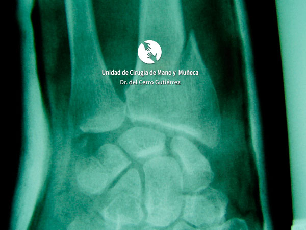 Fractura del Radio de la Muñeca Fractura del Radio. Fractura Extraarticular