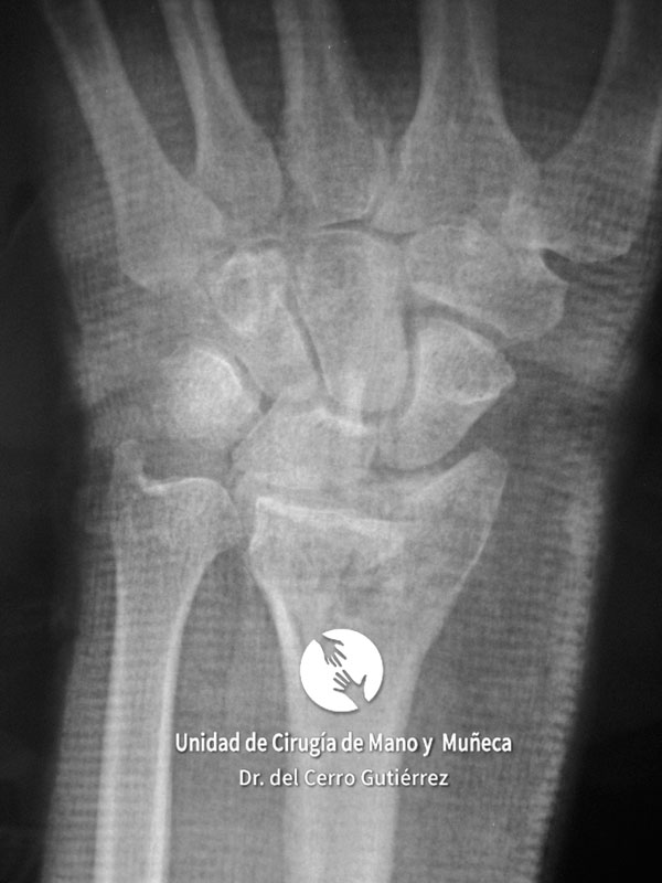 Fractura del Radio de la Muñeca Fractura del Radio. Fractura del Escafoides.