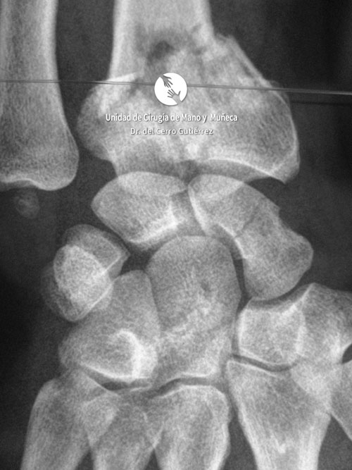 Fractura del Radio de la Muñeca Fractura del Radio. Fractura del Escafoides.