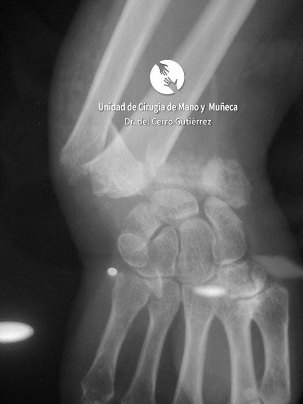 Fractura del Radio de la Muñeca Fractura del Radio. Conminuta y Articular.