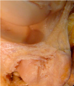 Lesión del Fibrocartílago Triangular Complejo del fibrocartílago triangular