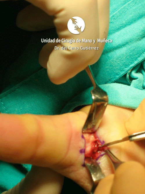 Dedo en Resorte o Gatillo Dedo en Resorte APERTURA POLEA. Imagen intraoperatoria