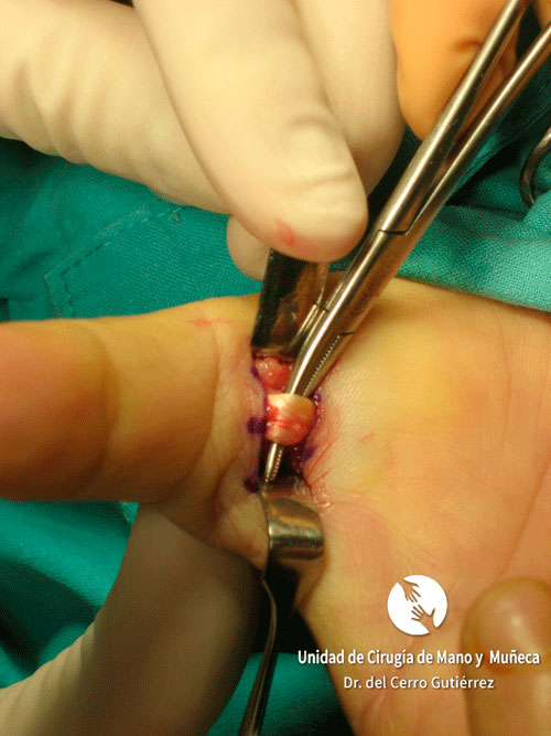 Dedo en Resorte o Gatillo Dedo en Resorte LIBERACION DEL TENDON