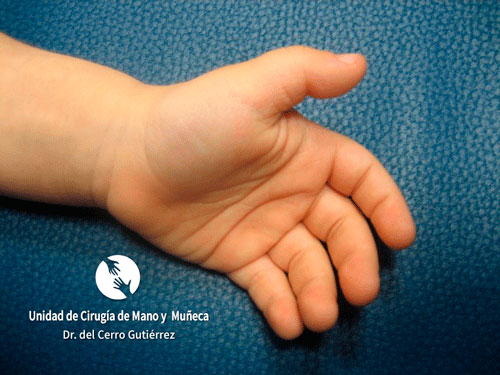 Dedo en Resorte o Gatillo Dedo en resorte en niños