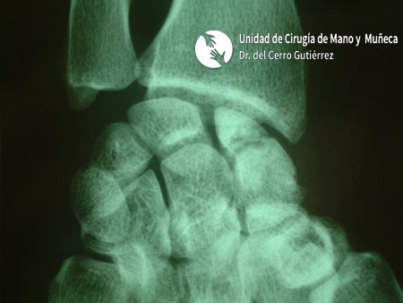 Fractura del Escafoides Fractura de escafoides de la mano. Polo Proximal