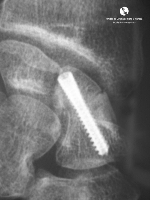 Fractura del Escafoides Fractura del Escafoides Injerto en Ps