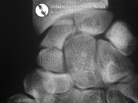 Fractura del Escafoides Fractura del Escafoides Pseudoartrosis del tercio medio
