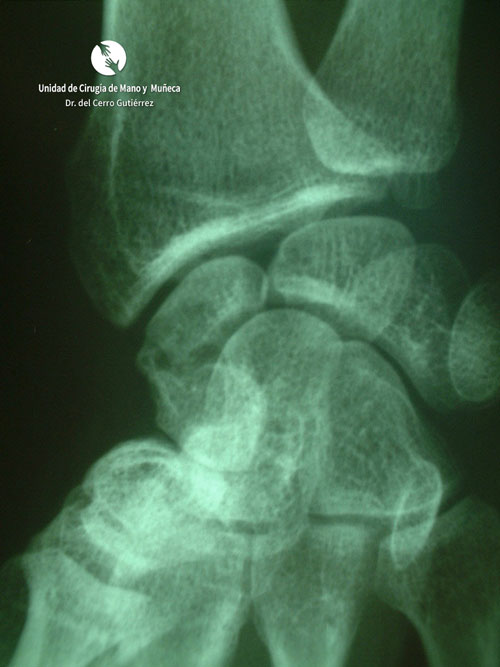 Fractura del Escafoides Fractura del Escafoides Pseudoartrosis escafoides injerto con tornillo