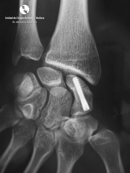 Fractura del Escafoides Fractura del Escafoides. Síntesis