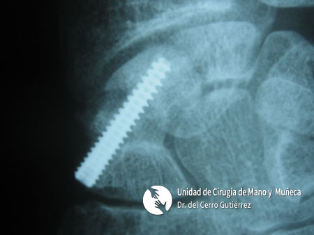 Fractura del Escafoides Fractura del Escafoides Tornillo con Injerto