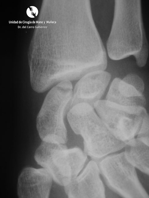 Fractura del Escafoides Fractura del Escafoides. Fractura del Polo Proximal