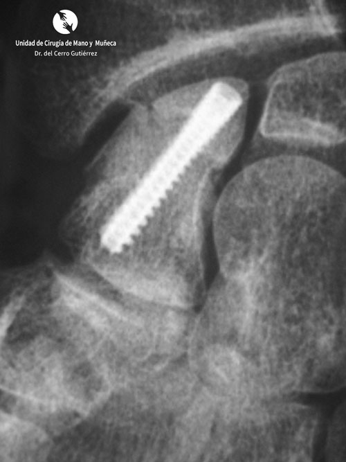 Fractura del Escafoides Fractura del Escafoides.Síntesis-Dorsal de Fractura
