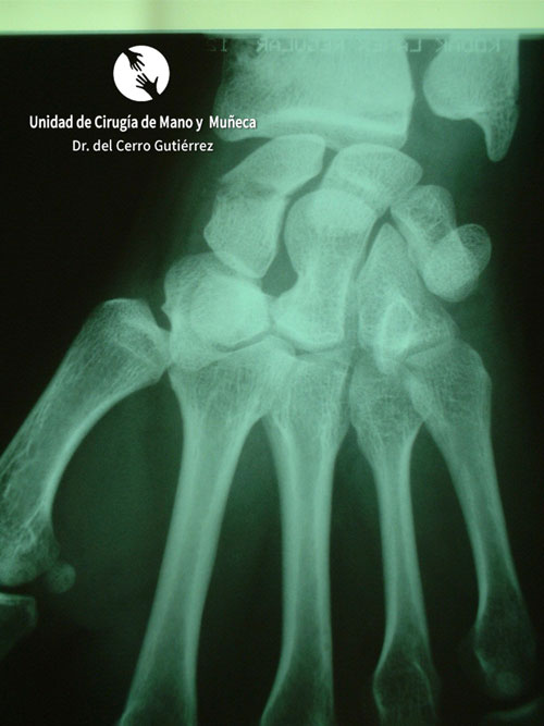 Fractura del Escafoides Fractura del Escafoides