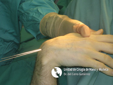 Fractura del Escafoides Fractura del Síntesis Percutánea Dorsal.