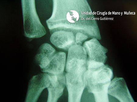 Fractura del Escafoides Fractura del polo proxima del escafoides de la mano