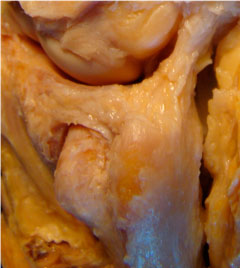 Lesión del Fibrocartílago Triangular Ligamentos radiocubitales