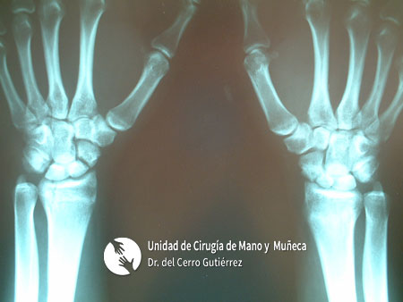 Fractura del Escafoides Pseudoartrosis bilateral del escafoides