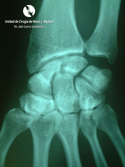 Fractura del Escafoides Pseudoartrosis del escafoides. Russe con agujas