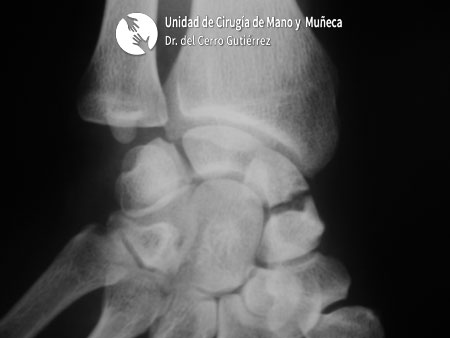 Fractura del Escafoides Pseudoartrosis del tercio medio