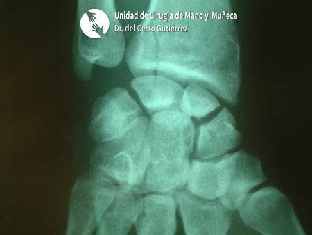 Fractura del Escafoides Pseudoartrosis. Inestabilidad Dorsal del Segmento Intermedio. DISI