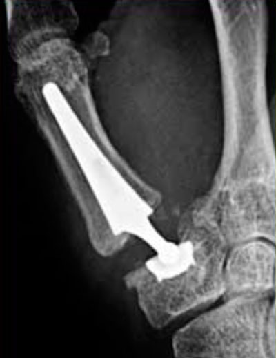 Rizartrosis Artrosis del Pulgar Rizartrosis 6