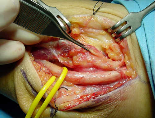Síndrome del Túnel Cubital del Codo epitrocleoplastia con fascia en el síndrome del túnel cubital