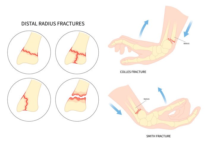 Fractura del Radio de la Muñeca fractura del radio distal