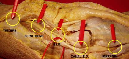 Síndrome del Túnel Cubital del Codo posibles zonas de compresión del nervio cubital en codo