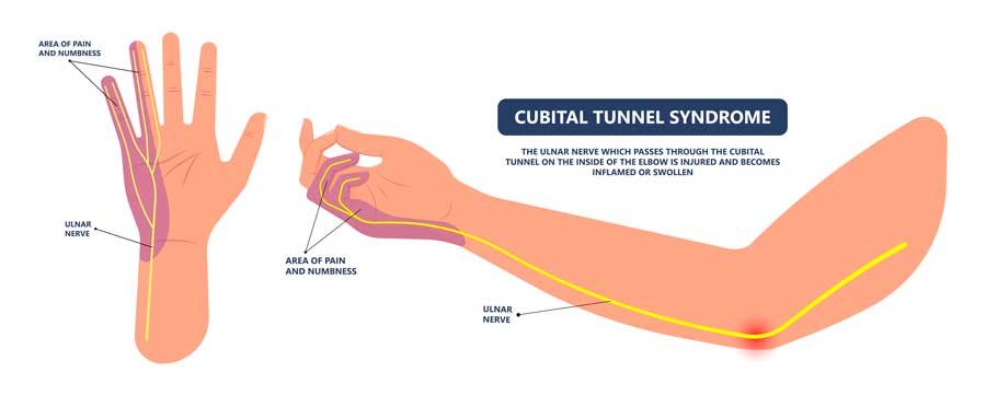 Síndrome del Túnel Cubital del Codo sindrome del túnel cubital