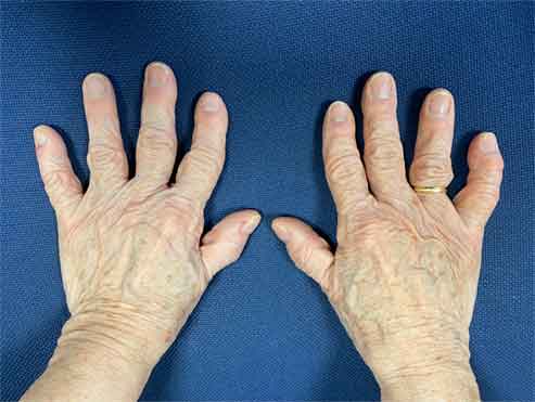 Mano Degenerativa artrosis y mano degenerativa