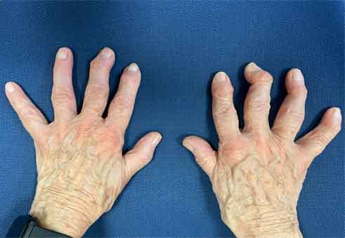 Mano Degenerativa artrosis y mano en la tercera edad