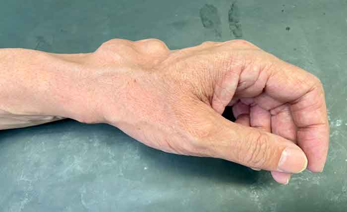 Tumores de Mano y Muñeca tumores benignos y malignos de la mano y muñeca