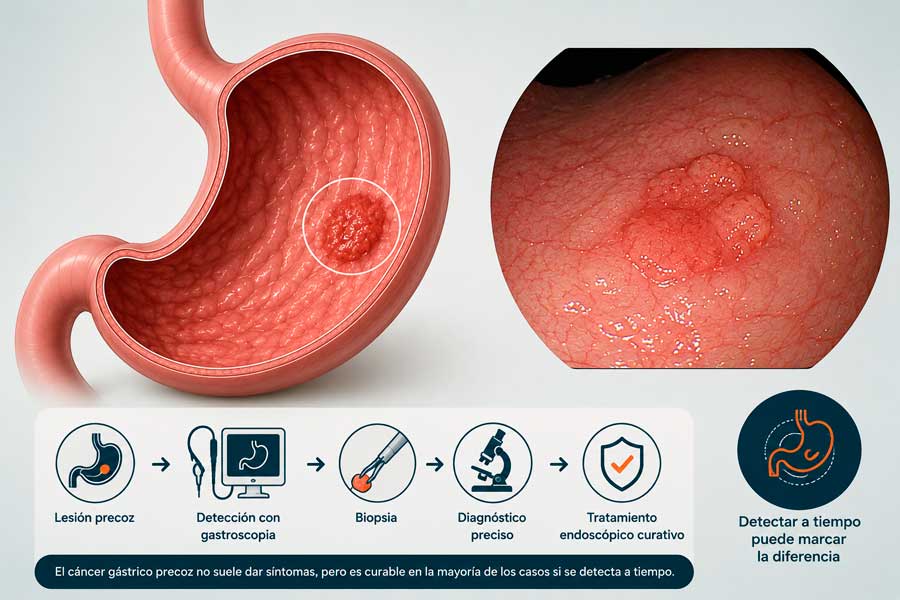 roceso de diagnóstico del cáncer gástrico precoz mediante gastroscopia y biopsia en Mérida y Don Benito, Badajoz