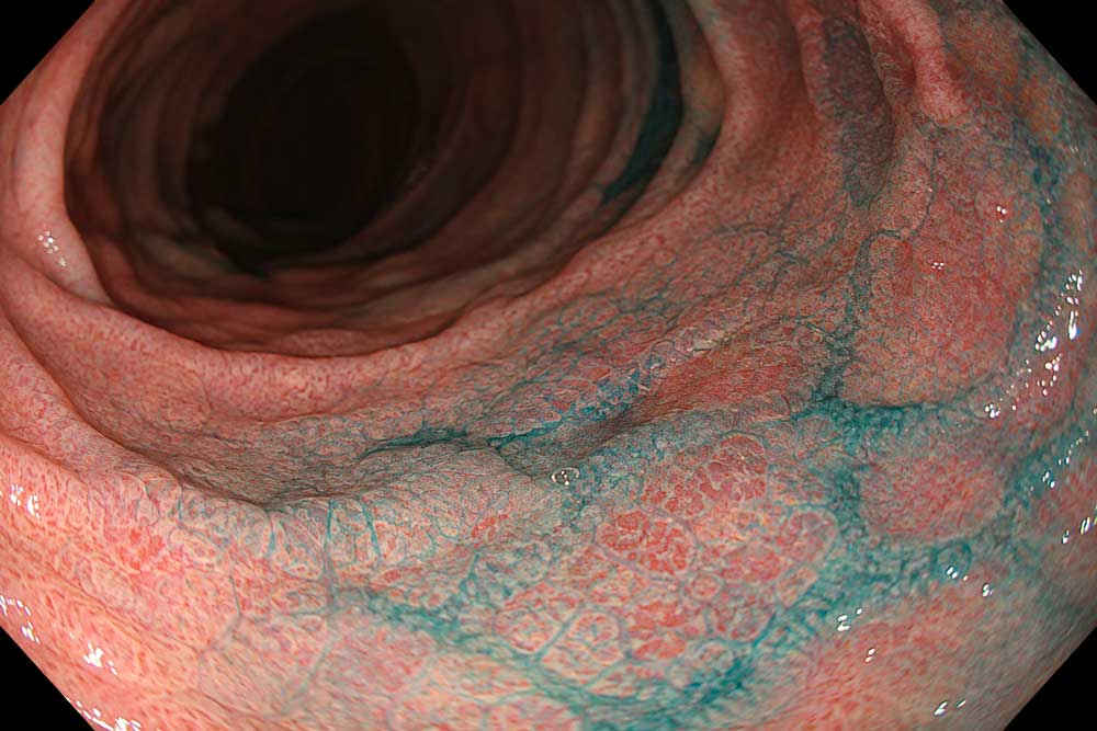 Representación anatómica del estómago utilizada para explicar las enfermedades gástricas y las lesiones premalignas como la metaplasia intestinal.