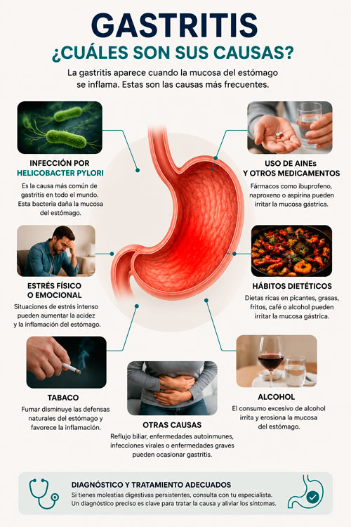 Infografía médica sobre las causas más frecuentes de la gastritis con representación anatómica del estómago.